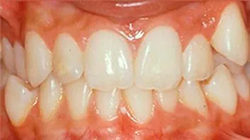 Dentadura con dientes desalineados antes del tratamiento