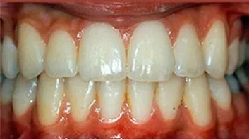 Dentadura alineada y saludable tras el tratamiento
