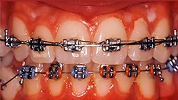 Dentadura con brackets durante el tratamiento de ortodoncia