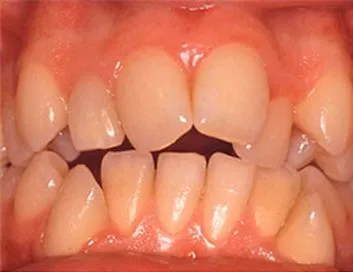 Dentadura con separación entre los dientes antes del tratamiento