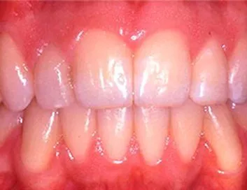 Dentadura corregida y alineada tras el tratamiento