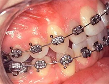 Brackets metálicos colocados durante el tratamiento