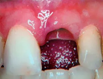 Encía con ausencia de una pieza dental antes del implante