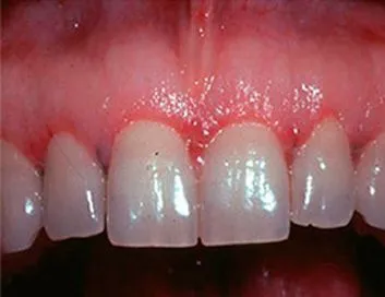 Pieza dental restaurada y encía sana tras el implante