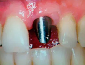 Implante dental colocado durante el tratamiento